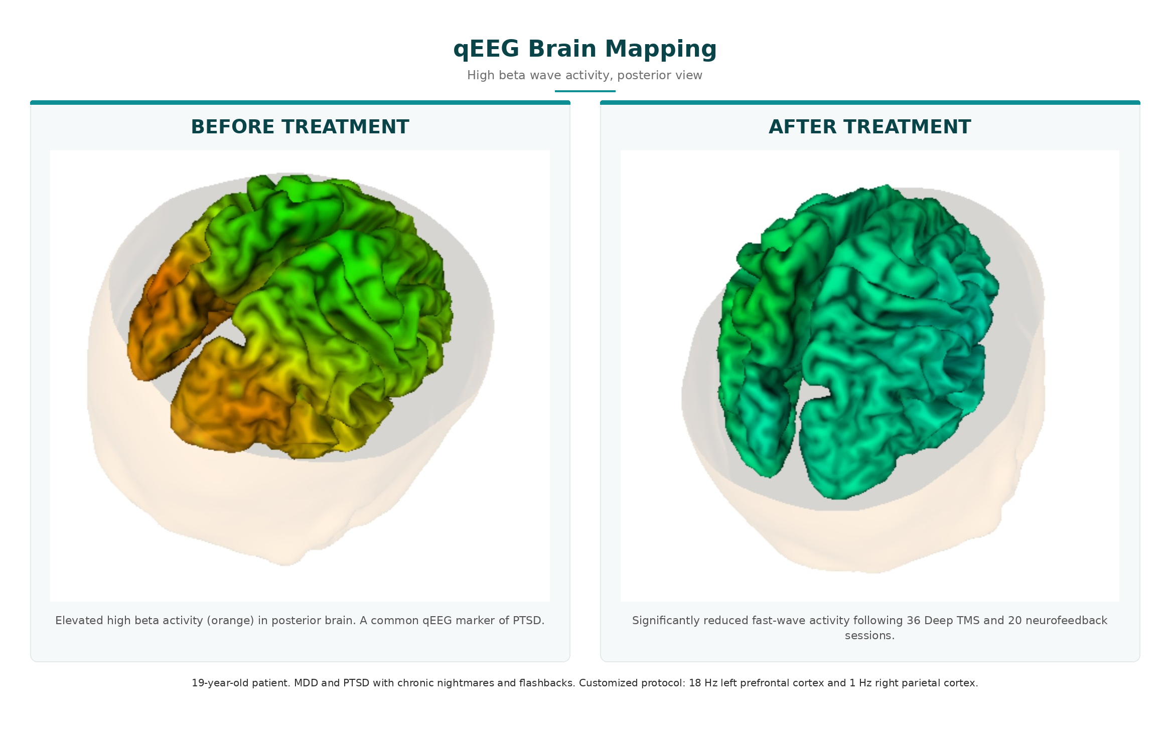 qEEG brain mapping showing reduced high beta activity in posterior brain following Deep TMS and neurofeedback for PTSD and MDD
