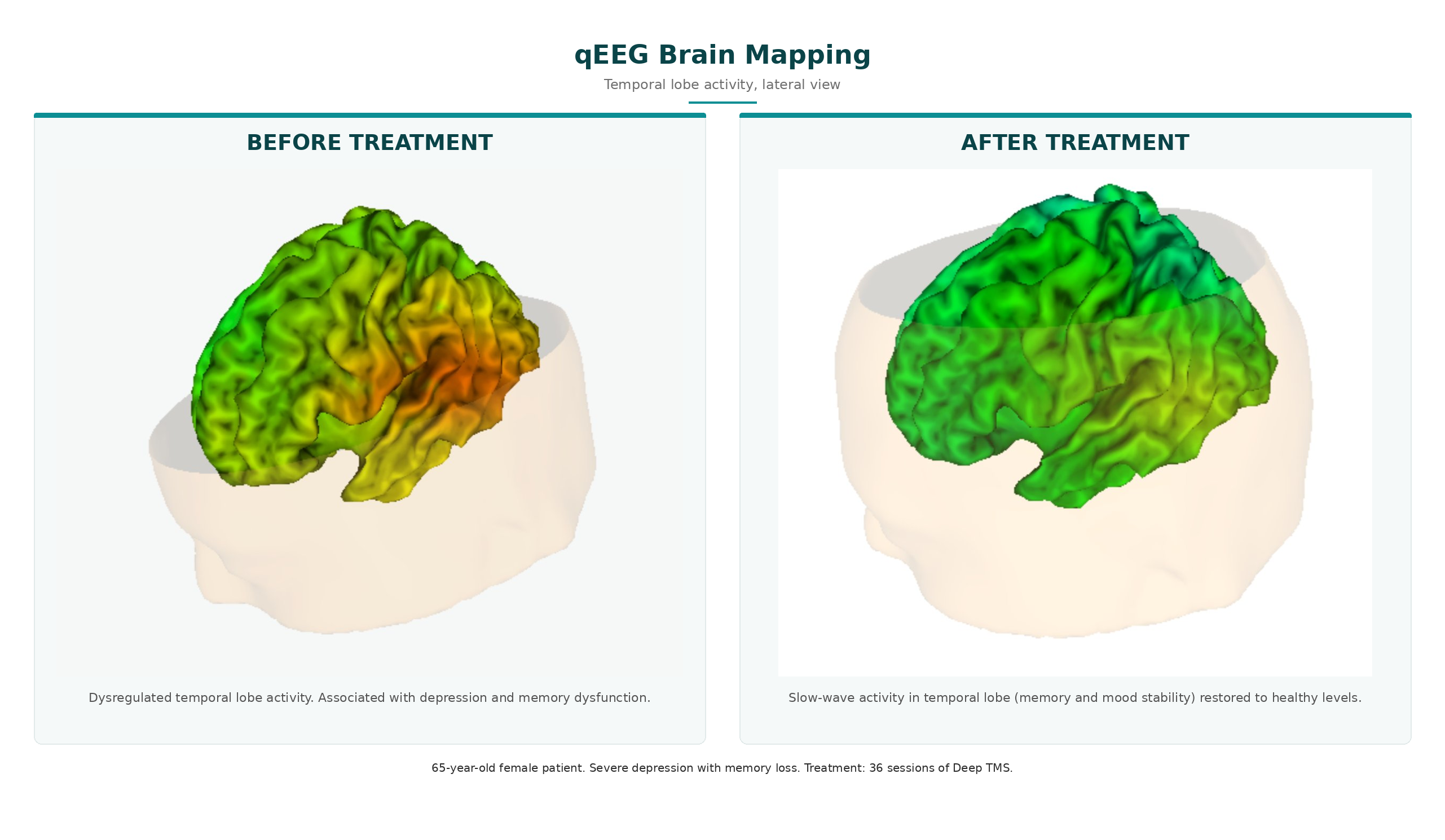 qEEG brain mapping showing restored temporal lobe activity following Deep TMS for severe depression and memory loss
