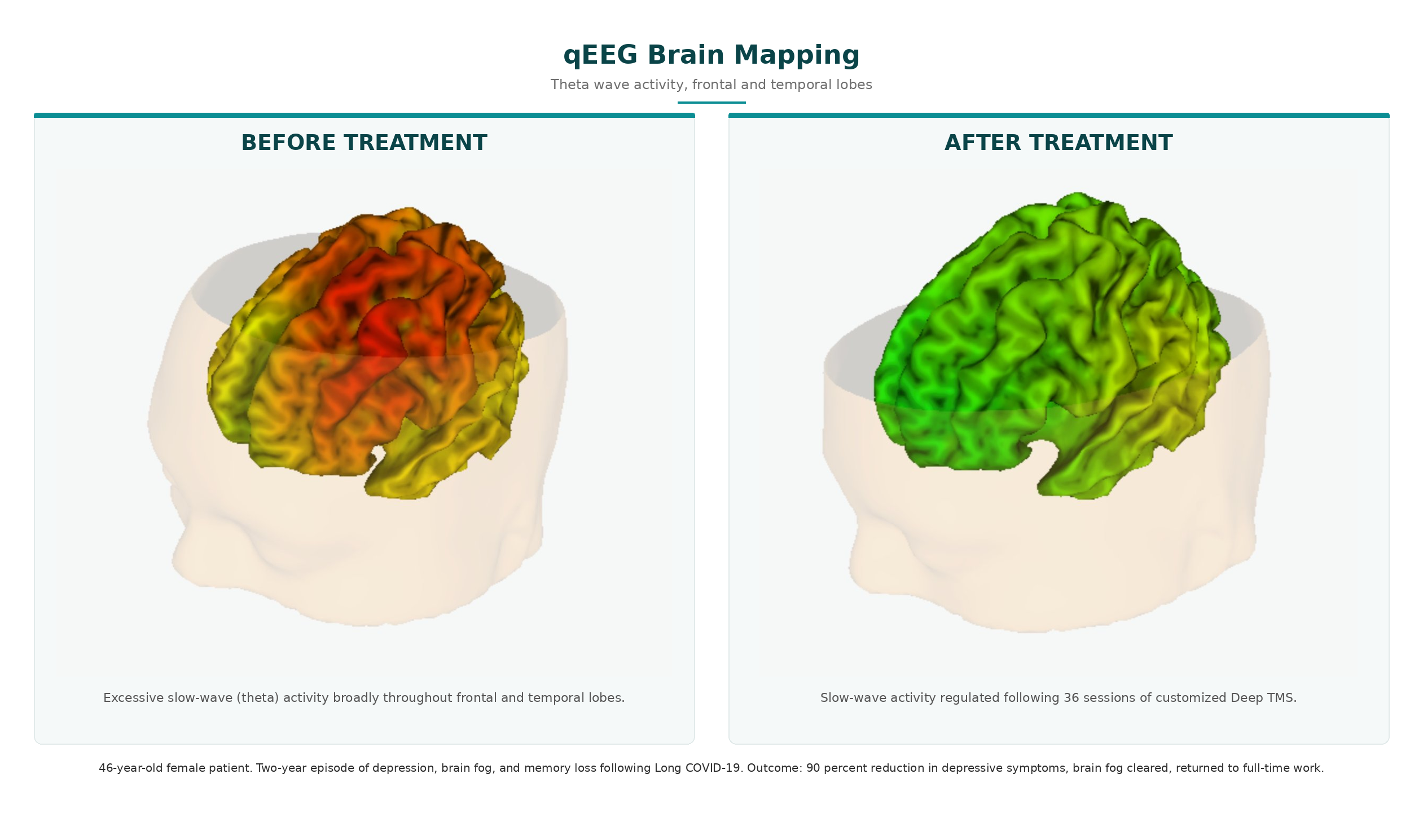 qEEG brain mapping showing reduction in theta wave activity following Deep TMS treatment for Long COVID symptoms