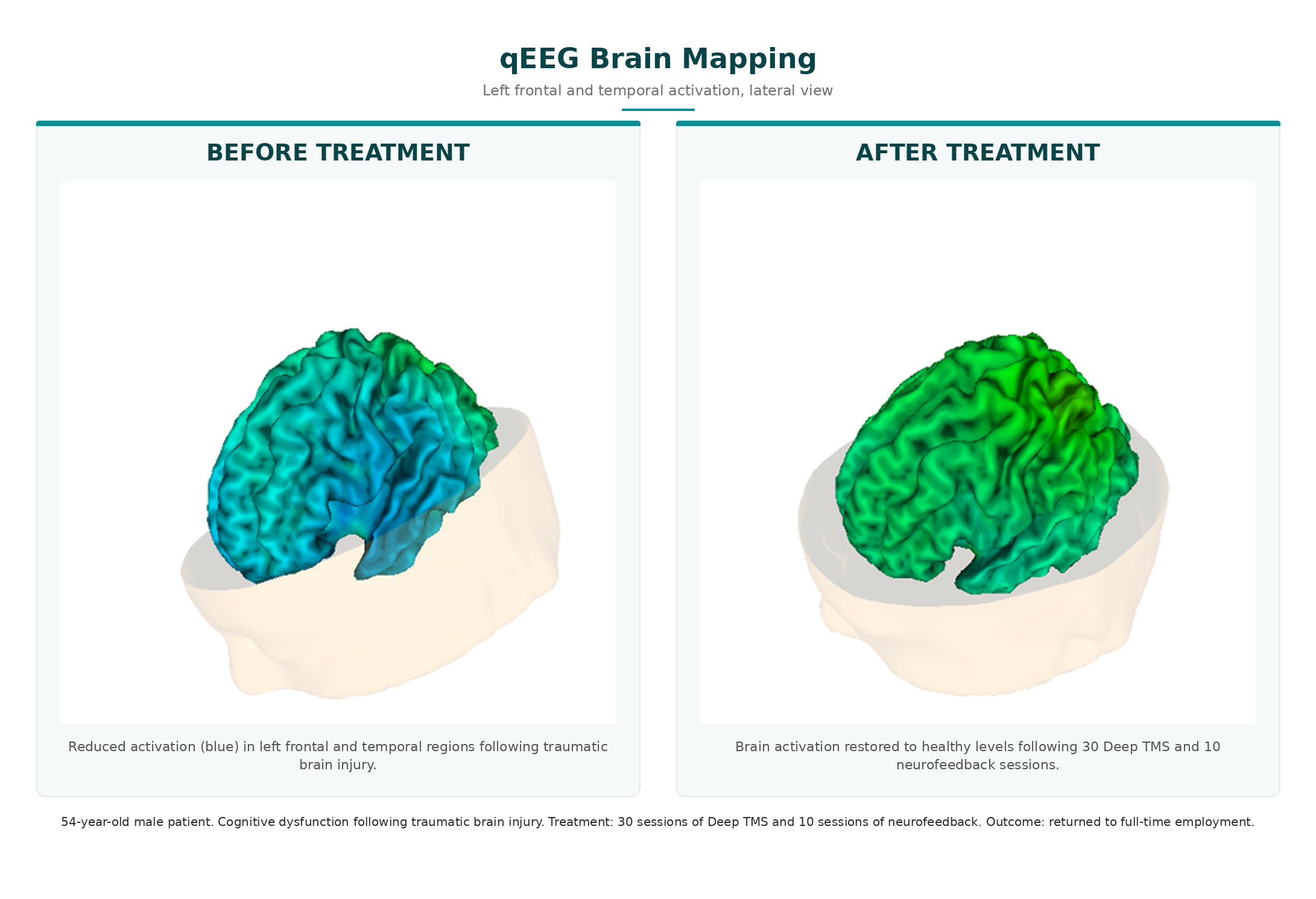 qEEG brain mapping showing restored activation in left frontal and temporal regions following Deep TMS for traumatic brain injury