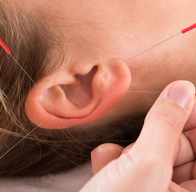 The Benefits of Auricular Acupuncture for Mental Health