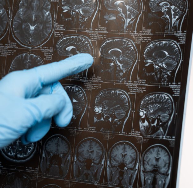 How TMS Brain Therapy Can Boost Brain Health