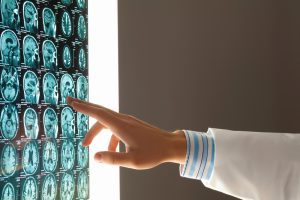 Neurofeedback for Concussions: A Path to Healing