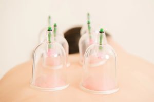 The Science Behind Cupping Therapy for Anxiety: Does It Work?