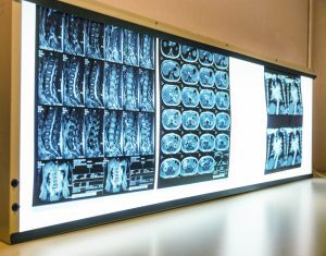 Is TMS Safe? The Safety of Transcranial Magnetic Stimulation
