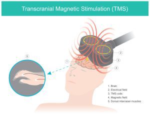 Is TMS Safe? The Safety of Transcranial Magnetic Stimulation