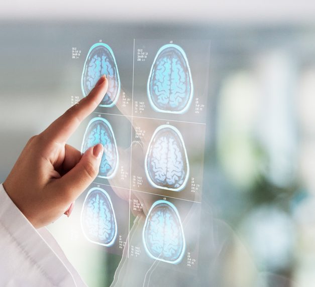 Pros and Cons of TMS Therapy: What You Need to Know