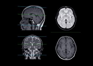 Pros and Cons of TMS Therapy: What You Need to Know