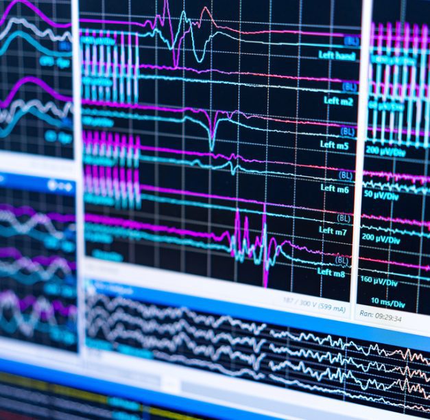 What Does a Personalized TMS Treatment Plan Look Like?