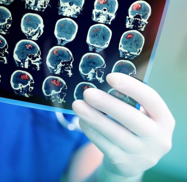 What It Feels Like to Undergo TMS Depression Treatment