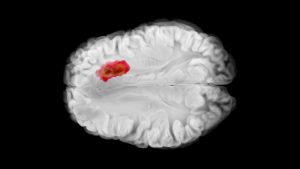 How Neuroimaging Can Improve Psychiatric Diagnosis Accuracy