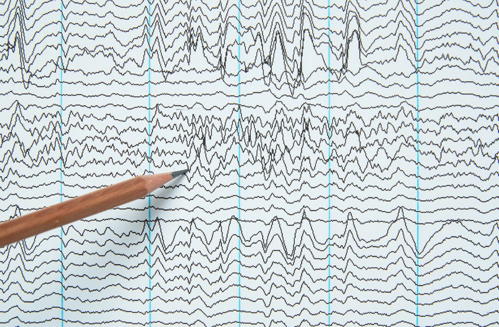Understanding Neurofeedback: How It Works and Who It Helps
